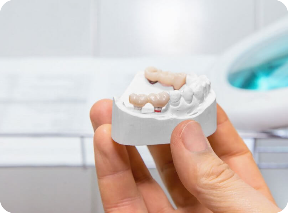 Implant dentaire