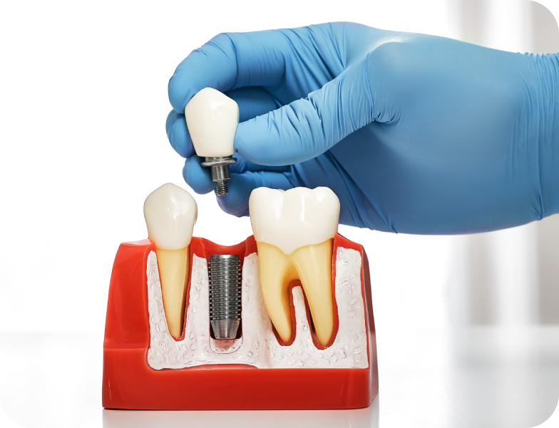 Implant dentaire
