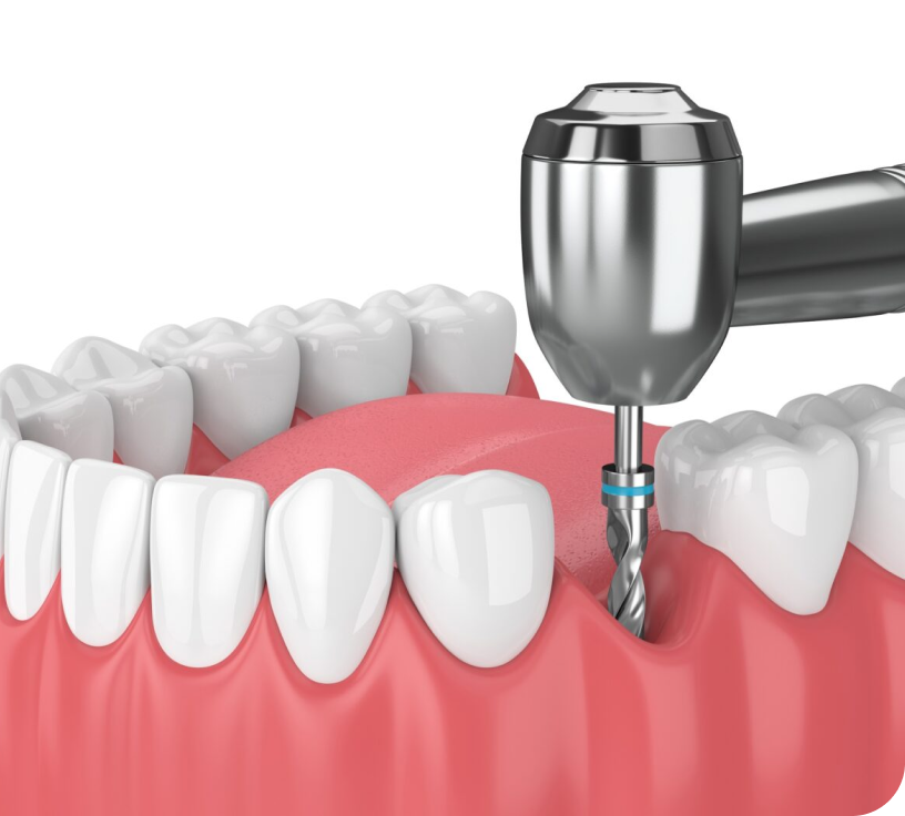 Implant dentaire